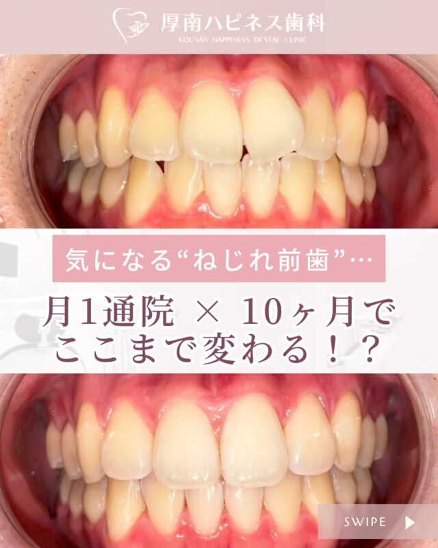 🦷【ねじれた前歯…10ヶ月でここまで変わる！？】
写真うつりが気になって…
マスクを外すのに勇気がいる毎日だったYさん。

ふと鏡を見たときに「前歯のねじれ」が気になり始め、
ご相談に来られました。

選んだのは、月1回の通院で進められる【マウスピース矯正】✨
少しずつ整っていく歯並びに、毎月楽しみが増え…
最終日には、自信に満ちた笑顔で帰られました☺️

「気になるけど、自分は後回し」
そんな方こそ、まずは相談から始めてみませんか？

━━━━━━━━━━━━━━━
📍山口県宇部市 厚南ハピネス歯科
📞083-643-6800
🦷 無料相談・カウンセリング受付中
━━━━━━━━━━━━━━━

💬気になるママは、ぜひ【保存】してあとでチェック📝
📲シェアも大歓迎です！

#厚南ハピネス歯科
#前歯矯正
#マウスピース矯正
#部分矯正
#山口市歯医者
#宇部市歯医者
#矯正相談受付中
#月1通院矯正
#ねじれ歯
#歯並び気になる