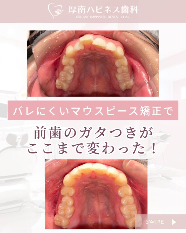 \ バレにくいマウスピース矯正で/
前歯のガタつきがここまでキレイに✨
「矯正したいけど、仕事もしてるし…」
そんなお悩みをお持ちだった患者さま。
目立ちにくいマウスピース矯正で、
お仕事にも支障なく治療を進められました🌿
🔽Before
前歯のデコボコや前後のズレが気になっていた状態から…
🔽After
ズレが整い、すっきりとしたキレイな歯並びに!✨
ご本人も「思ったよりスムーズだった」と喜ばれていました☺️
📣患者さまの声
「期間もそこまで長く感じず、仕事の支障もありませんでした」
安心して通えることも、当院の強みです🪥
━━━━━━━━━━━━━━━
🦷症例やお口の状態により、最適な治療法をご提案します
🦷まずはお気軽にご相談ください
📍厚南ハピネス歯科
📞0836-43-6800
山口県宇部市厚南北1丁目3-23 際波グランフォート3号
━━━━━━━━━━━━━━━
💬「自分もできるかな?」と思ったら、
DM・お電話でお気軽にご相談くださいね✨
気になったら【保存】して後でゆっくり見るのもおすすめです📲
#厚南ハピネス歯科 #マウスピース矯正 #目立たない矯正
#宇部市矯正歯科 #山口県歯医者 #大人の矯正 #歯並び改善
#女性に人気の歯科医院 #症例紹介 #矯正治療記録 #歯科Instagram