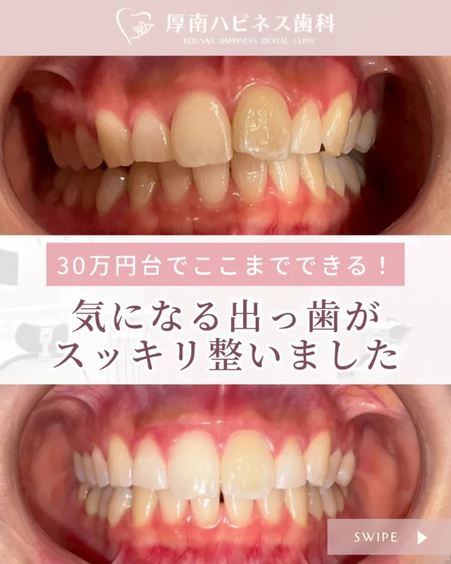 🦷【症例紹介】

＼気になる「出っ歯」もスッキリ改善✨／
30万円台でも、ここまで整いました！

「出っ歯が気になるけど、費用も心配…」
そんな思いでご来院された19歳の女性患者さま。
約1年の矯正治療で、
しっかりと歯並びを整えることができました☺️

📌治療DATA
・年齢：19歳女性
・治療期間：約1年
・費用：¥330,000（税込）〜

💬 ご本人の声
「価格も安心で、スタッフさんと話しながら楽しく治療ができました！」
笑顔がどんどん増えていくのを、スタッフも感じていました😊

📣こんな方におすすめ
「前歯の出っ張りが気になる」
「費用をできるだけ抑えたい」
「目立ちにくく矯正したい」
そんな方も、ぜひ一度ご相談ください✨

━━━━━━━━━━━━━━━
🦷厚南ハピネス歯科🦷
✔ 費用も期間も明確にご提案
✔ 無理のないペースで進められます
━━━━━━━━━━━━━━━

📍宇部市厚南北1丁目3-23 際波グランフォート3号
📞0836-43-6800
📲 ご相談・予約はお電話またはプロフィールリンクから💡

気になったら【保存】して、後からゆっくりご覧ください♪

#厚南ハピネス歯科 #宇部市歯医者 #山口県矯正歯科
#出っ歯改善 #マウスピース矯正 #部分矯正 #費用相談OK
#前歯が気になる #矯正治療記録 #症例紹介 #安心して通える歯科医院