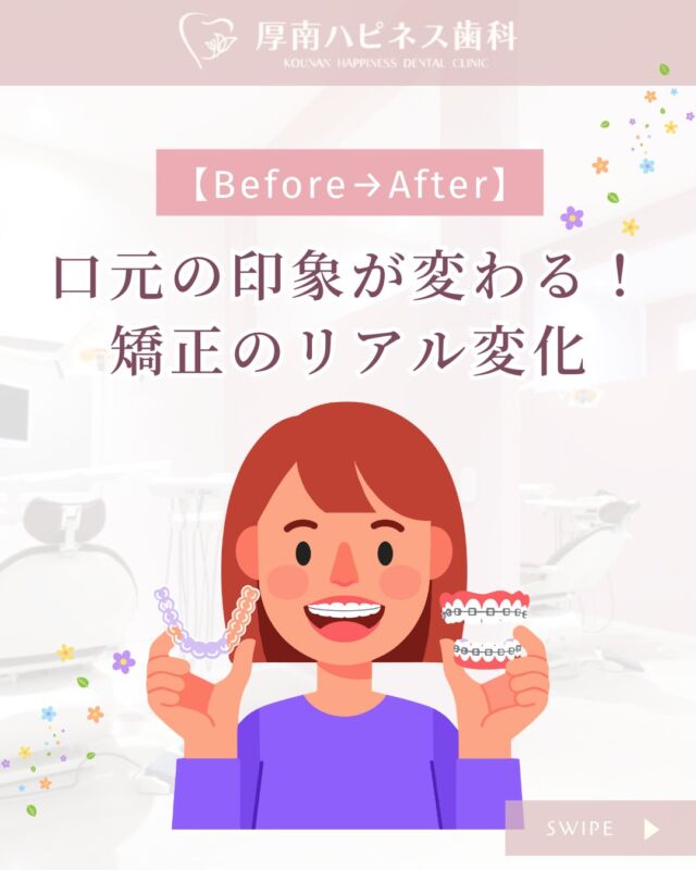 【Before→After公開📸】

＼たった10ヶ月でここまで変わる！？／
矯正の“リアルな変化”をご紹介します✨

「矯正って実際どれだけ変わるの？」
「見た目や費用、期間が気になる…」
そんな疑問にお応えする投稿です🪞

🦷【症例① Yさん】
噛み合わせのズレが気になって10ヶ月の治療。
→ 短期間ですっきり整い、自信のある口元に！

🦷【症例② Hさん】
「職場でバレたくない…」とスタートした矯正も
→ 目立たず治療できて大満足！

🦷【症例③ Nさん】
前歯の“出っ歯”が気になっていたけれど
→ 整ったことで自然な笑顔に変化✨

📌治療費：33〜55万円（税込）
📌治療期間：6ヶ月〜1年目安
📌透明なマウスピース矯正対応
📌目立ちにくく、痛みも少ないのが特長！

🩵厚南ハピネス歯科では、
見た目だけでなく機能面にもこだわった矯正治療を行っています。

「まず相談だけしたい」でもOK！
お気軽にご予約・ご相談ください📞

――――――――――――――――
📍山口県宇部市｜厚南ハピネス歯科
📞0836-43-6800
🪄ご予約・無料カウンセリングはプロフィールリンクから
――――――――――――――――

📌【保存】して見返しOK
🫶「いいね♡」やシェアも大歓迎です！

#矯正ビフォーアフター #マウスピース矯正
#山口県矯正歯科 #宇部市歯医者 #厚南ハピネス歯科
#矯正変化 #矯正中 #矯正後 #目立たない矯正
#出っ歯矯正 #噛み合わせ改善 #大人の矯正 #笑顔に自信