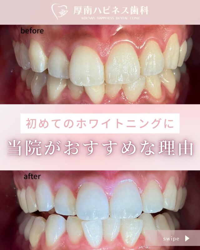 【矯正ってどれくらい変わる？】
￣￣￣￣￣￣￣￣￣￣￣￣￣￣￣￣
「少しの凸凹でも印象って変わるの？」
そんな疑問をもつ方に、実際のBefore→Afterをご紹介✨

治療期間：約10ヶ月〜1年
費用：33〜55万円〜

短期間でもここまで変わるんです。
まずは無料相談で、自分に合う方法を知ることから始めませんか？☺️

――――――――――――――――
📍厚南ハピネス歯科｜宇部市厚南
📞 0836-43-6800
🪥 ご相談・ご予約はプロフィールリンクから
――――――――――――――――

📌「後で見たい！」と思ったら【保存】
🫶「参考になった！」と思ったら【いいね】お願いします♡

#宇部市矯正歯科 #マウスピース矯正山口 #厚南ハピネス歯科 
#矯正ビフォーアフター #八重歯 #歯並び改善 #目立たない矯正 
#山口矯正歯科 #無料相談受付中 #歯の美容