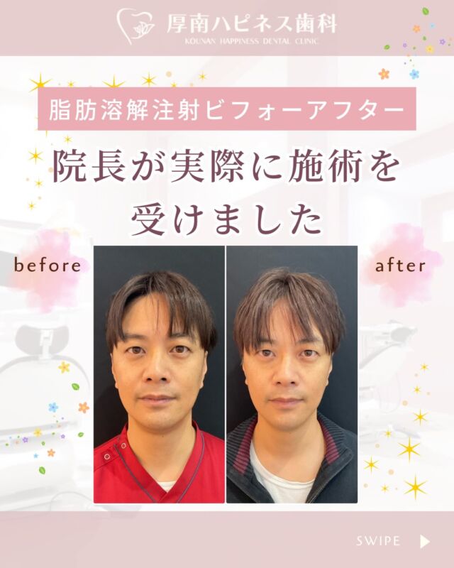 ✨脂肪溶解注射 ビフォーアフター✨
＼院長が実際に施術を受けました／

「自分が受けていない施術は、勧めません。」

宇部市でも美容のご相談が増えている中で、
院長自身が脂肪溶解注射を体験しました。

当院が大切にしているのは
🦷歯科だからできる“バランス重視”の美容。

噛み合わせ・骨格・筋肉の動きなど
歯科医療の視点から、
口元と顔全体のバランスを見ながら整えていきます。

脂肪溶解注射は
✔急激に変える施術ではなく
✔徐々に自然に変化していく施術

目指すのは
「なんかスッキリした？」と言われる
自然な印象の変化です✨

また当院では
✔単発施術OK
✔無理な契約・押し売りなし

まずは相談だけでも大歓迎です😊

宇部市で安心できる口元美容を。

気になる方はお気軽にご相談ください。

保存して後で見返したい方は
🔖【保存】がおすすめです。

――――――――――――――――
📍山口県宇部市｜厚南ハピネス歯科
📞0836-43-6800
🪄ご予約・無料相談はプロフィールリンクから
――――――――――――――――
#脂肪溶解注射
#口元美容
#フェイスライン改善
#小顔治療
#美容歯科