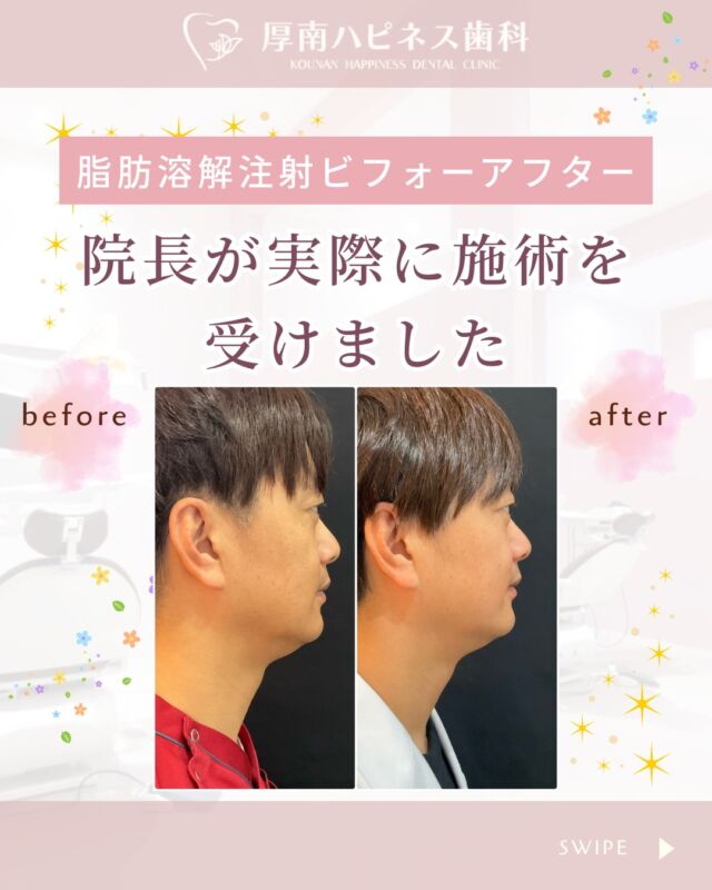 ✨脂肪溶解注射 ビフォーアフター✨
＼院長が実際に施術を受けました／

「自分が受けていない施術は、勧めません。」

宇部市でも美容のご相談が増えている中で、
院長自身が脂肪溶解注射を体験しました。

当院が大切にしているのは
🦷歯科だからできる“バランス重視”の美容。

噛み合わせ・骨格・筋肉の動きなど
歯科医療の視点から、
口元と顔全体のバランスを見ながら整えていきます。

脂肪溶解注射は
✔急激に変える施術ではなく
✔徐々に自然に変化していく施術

目指すのは
「なんかスッキリした？」と言われる
自然な印象の変化です✨

また当院では
✔単発施術OK
✔無理な契約・押し売りなし

まずは相談だけでも大歓迎です😊

宇部市で安心できる口元美容を。

気になる方はお気軽にご相談ください。

保存して後で見返したい方は
🔖【保存】がおすすめです。

――――――――――――――――
📍山口県宇部市｜厚南ハピネス歯科
📞0836-43-6800
🪄ご予約・無料相談はプロフィールリンクから
――――――――――――――――
#口元美容
#フェイスライン改善
#小顔治療
#美容歯科
#宇部市歯医者
#宇部市美容
#山口県歯医者
#厚南ハピネス歯科
#ビフォーアフター
#美容医療初心者歓迎