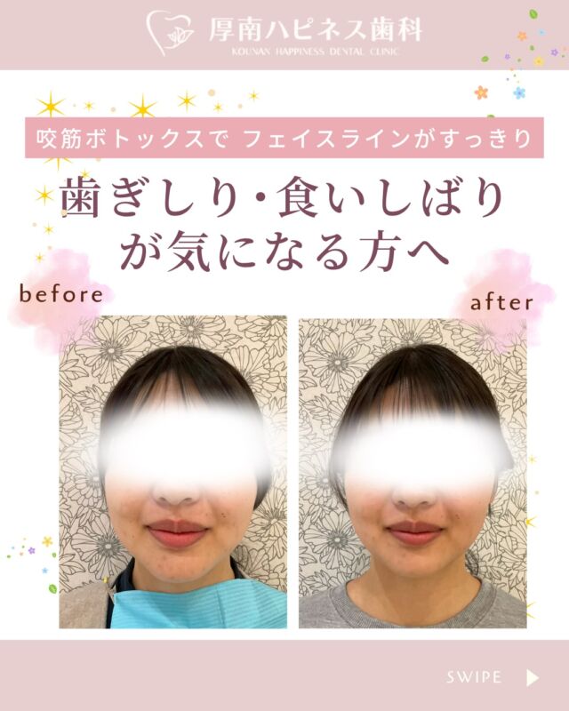 歯ぎしり・食いしばりが気になる方へ

歯ぎしりや食いしばりの原因のひとつに、
 あごの筋肉（咬筋）の過度な緊張があります。

咬筋にボツリヌス注射を行うことで、
 筋肉の働きをやわらげ、
 歯ぎしりや食いしばりの緩和が期待できます。

また、咬筋の張りがやわらぐことで
 フェイスラインがすっきりするという
 見た目の変化を感じる方もいらっしゃいます。

施術は約10分ほどで、
 ダウンタイムもほとんどありません。

 数日で効果があらわれ、
 約半年ほど持続が期待できます。

歯ぎしり・食いしばり、あごの張りが気になる方は
お気軽にご相談ください。

宇部市で
安心できる口元美容なら
厚南ハピネス歯科へ。

📌あとで見返したい方は
【保存】がおすすめです。

――――――――――――――――
📍山口県宇部市｜厚南ハピネス歯科
📞0836-43-6800
🪄ご予約・無料相談はプロフィールリンクから
――――――――――――――

#歯ぎしり
 #食いしばり
 #咬筋ボトックス
 #ボツリヌス注射
 #顎関節症