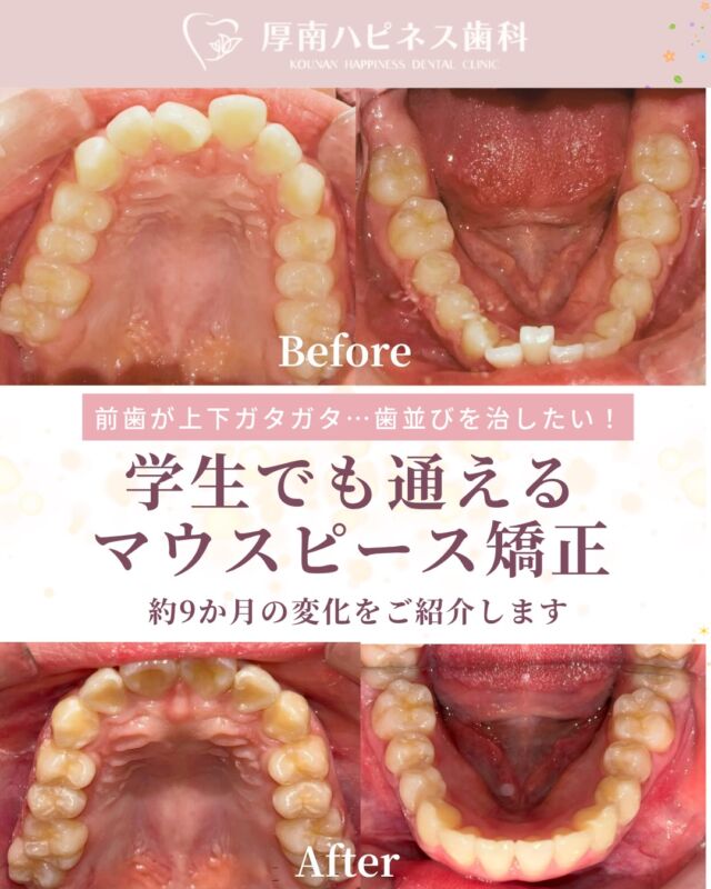 今回は 16歳の患者様の矯正症例をご紹介します。

「前歯のガタガタが気になる」と
 お母様と一緒に相談で来院されました。

目立ちにくい矯正方法をご希望され
 マウスピース矯正を選択。

学業の合間をぬって
 月1回程度の通院を続けていただき
 約9か月で歯並びが整いました。

ビフォーアフターの写真をお見せすると
 とても嬉しそうなご様子でした。

現在は透明アライナーで保定中です。
歯並びが整うことで
 笑顔にも自信が持てるようになります。
歯並びが気になる方は
 お気軽にご相談ください。
※治療期間・費用には個人差があります

宇部市で
安心できる口元美容なら
厚南ハピネス歯科へ。

📌あとで見返したい方は
【保存】がおすすめです。

――――――――――――――――
📍山口県宇部市｜厚南ハピネス歯科
📞0836-43-6800
🪄ご予約・無料相談はプロフィールリンクから
――――――――――――――

#矯正ビフォーアフター #マウスピース矯正
#山口県矯正歯科 #宇部市歯医者 #厚南ハピネス歯科