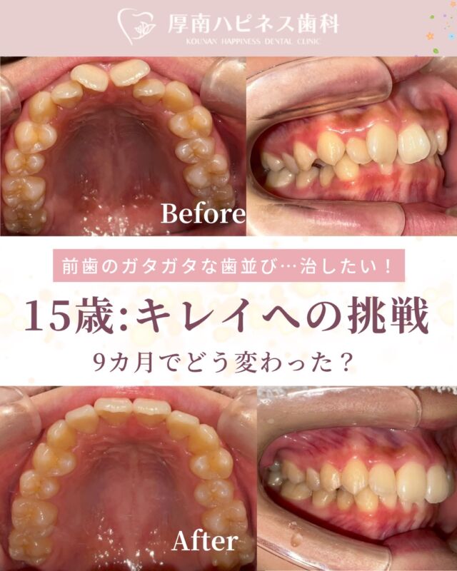 「前歯のガタガタを治したい」
 そんな思いで来院された、15歳の女の子。
選ばれたのは
 目立ちにくいマウスピース型のアライナー矯正でした。
でも、治療を始めてすぐに
 「着脱の難しさ」という壁に直面。
「全然外れない…」と
 最初は苦戦する場面もありました。
それでも諦めず 何度も練習を重ねながら
 少しずつ慣れていきました。
部活動で忙しい毎日。
 それでもご自身でしっかり管理しながら
 治療を続けてくれました。
月に一度お会いするたびに 笑顔が増えていくのが
 とても印象的でした。
「部活にも全然支障なかったです！」
 と教えてくれたことも。
そして迎えた最終日。
アタッチメントを外し 鏡を見た瞬間にこぼれた一言。
「めっちゃキレイ！！！」
その笑顔が とても印象に残っています。
歯並びが整うことで 笑顔に自信が生まれることもあります。
お子さんの歯並びが気になる方は お気軽にご相談ください
矯正を検討されている方は
 保存してあとで見返してください