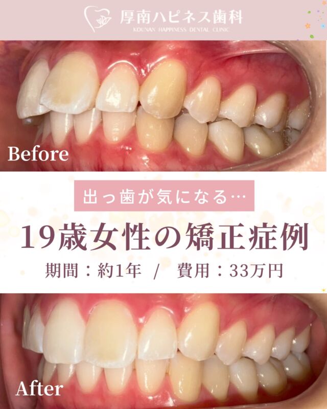 【矯正症例のご紹介】

前歯の出っ歯が気になる、というお悩みで来院された19歳女性の患者様の症例です。

初診の際は少し緊張されたご様子でしたが、
治療が進むにつれて笑顔が増え、
会話も弾むようになっていきました。

歯並びが整っていく変化を前向きに感じてくださり、
「将来は歯科関係の仕事に携わりたい」と
お話してくださったのが印象的でした。

矯正治療は、見た目を整えるだけでなく

・口元の印象を整える（審美）
・噛み合わせを整える（咬合）
・歯磨きがしやすくなり虫歯予防につながる

といったメリットがあります。

今回の症例では

治療期間：約1年
費用：約33万円

で治療を行うことができました。

矯正治療は歯並びの状態によって
治療方法や期間、費用が変わります。

ケースによっては、今回のように
標準より費用を抑えて治療できる場合もあります。

「矯正は高そう…」と迷っている方も、
まずはご自身の場合どのくらいの期間・費用になるのか知ることから始めてみませんか？

当院ではお一人おひとりのお口の状態に合わせて
治療方法をご提案しています。

気になる方はお気軽にご相談ください。

宇部市で
安心できる口元美容なら
厚南ハピネス歯科へ。

📌あとで見返したい方は
【保存】がおすすめです。

――――――――――――――――
📍山口県宇部市｜厚南ハピネス歯科
📞0836-43-6800
🪄ご予約・無料相談はプロフィールリンクから
――――――――――――――――

#宇部市歯医者
#宇部市歯科
#宇部市美容
#宇部市審美歯科
#歯科美容