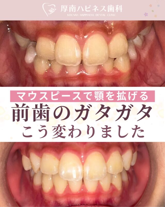 前歯のガタつき、少しずつ変化しています🦷

今回は 
マウスピース矯正開始から5か月の経過をご紹介。

「歯並びを整えたいけど、大がかりな矯正は不安…」 
そんなご相談からスタートしました。

歯をきれいに並べるためには、 
見た目だけでなく歯が並ぶスペースを
確保することも大切です。

✔ 前歯のデコボコが気になる 
✔ できるだけ目立たず矯正したい 
✔ 自分の場合どのくらい変わるか知りたい

そんな方の参考になれば嬉しいです✨

※歯並び・治療期間・費用は個人差があります 
まずはカウンセリングでお気軽にご相談ください。

📩 ご予約・ご相談はプロフィールリンクから

宇部市で
安心できる口元美容なら
厚南ハピネス歯科へ。

📌あとで見返したい方は
【保存】がおすすめです。

――――――――――――――――
📍山口県宇部市｜厚南ハピネス歯科
📞0836-43-6800
🪄ご予約・無料相談はプロフィールリンクから
――――――――――――――

#矯正ビフォーアフター #マウスピース矯正
#山口県矯正歯科 #宇部市歯医者 #厚南ハピネス歯科
