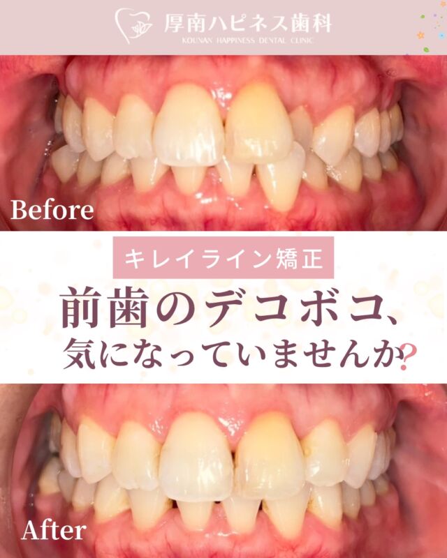 ＼ 前歯のガタつき、気になっていませんか？🦷 ／

「前歯をきれいに整えたい」
というご相談から始まった
マウスピース矯正の症例です。

装着当初は違和感がありましたが、
約2か月ほどで慣れ、
無理なく治療を継続されました。

治療終了時には
「思ったより短期間でした」とのお声も✨

歯並びを整えることは、
見た目の印象だけでなく

✔ 笑顔への自信 
✔ 歯みがきのしやすさ 
✔ お口の健康維持 

にもつながります。

「矯正って自分にも必要？」

「どれくらい変わるの？」

そんな疑問をお持ちの方は、
まずはカウンセリングでお気軽にご相談ください。

――――――――――
【症例情報】
主訴：前歯部叢生（前歯のガタつき）
治療期間：約9か月
費用：¥550,000〜
※治療期間・費用は症例により異なります
――――――――――

📩 ご相談・ご予約はプロフィールリンクから

宇部市で
安心できる口元美容なら
厚南ハピネス歯科へ。

📌あとで見返したい方は
【保存】がおすすめです。

―――――――――――――
📍山口県宇部市｜厚南ハピネス歯科
📞0836-43-6800
🪄ご予約・無料相談はプロフィールリンクから
―――――――――――――

#矯正ビフォーアフター #マウスピース矯正
#山口県矯正歯科 #宇部市歯医者 #厚南ハピネス歯科