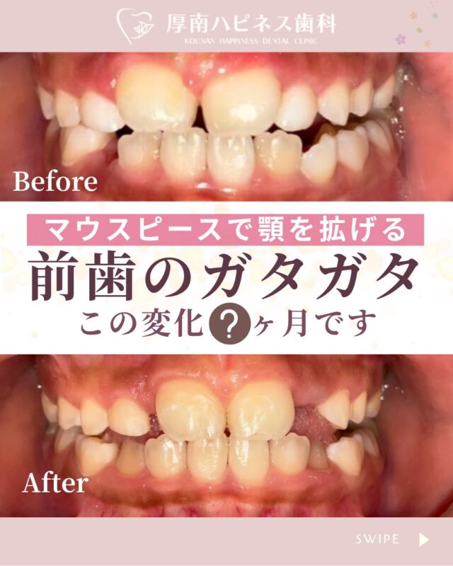 前歯のガタつき、気になっていませんか？🦷

今回は 
マウスピース矯正開始から5か月の変化をご紹介します。

「矯正って時間がかかりそう…」 
そんなイメージをお持ちの方も多いですが、 
少しずつ歯並びは変化していきます。

✔ 前歯のデコボコが気になる 
✔ 目立ちにくい矯正をしたい 
✔ 自分の場合どれくらい変わるか知りたい

そんな方の参考になれば嬉しいです。

歯並び・治療期間・費用は
お口の状態により異なります。 
まずはカウンセリングでお気軽にご相談ください✨
※治療期間・費用には個人差があります

📩 ご相談・ご予約はプロフィールから

宇部市で
安心できる口元美容なら
厚南ハピネス歯科へ。

📌あとで見返したい方は
【保存】がおすすめです。

――――――――――――――
📍山口県宇部市｜厚南ハピネス歯科
📞0836-43-6800

🪄ご予約・無料相談はプロフィールリンクから
――――――――――――――

#矯正ビフォーアフター #マウスピース矯正
#山口県矯正歯科 #宇部市歯医者 #厚南ハピネス歯科