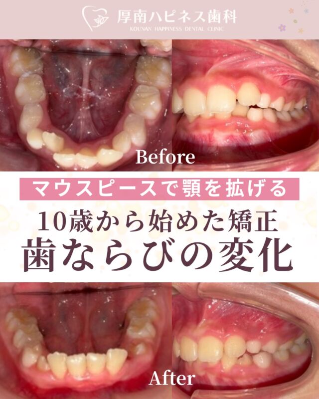 ＼10歳から始めた矯正治療🦷／

「前歯のガタつきが気になる」 
というご相談からスタートした矯正治療。

成長期だからこそ、 
歯がきれいに並ぶためのスペースを確保しながら 
無理なく歯並びを整えていきます。

歯並びを整えることは、見た目だけでなく 
✔ 食事がしやすくなる 
✔ むし歯・歯周病予防につながる 
✔ 将来のお口の健康を守る 
といったメリットもあります✨

お子さまの歯並びで気になることがあれば、 
まずはお気軽にご相談ください。

※歯並び・治療期間・費用は個人差があります

宇部市で
安心できる口元美容なら
厚南ハピネス歯科へ。

📌あとで見返したい方は
【保存】がおすすめです。

――――――――――――――――
📍山口県宇部市｜厚南ハピネス歯科
📞0836-43-6800
🪄ご予約・無料相談はプロフィールリンクから
――――――――――――――

#矯正ビフォーアフター #マウスピース矯正
#山口県矯正歯科 #宇部市歯医者 #厚南ハピネス歯科