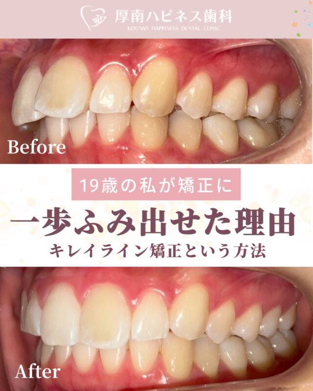 【19歳の私が矯正に踏み出せた理由】

「前歯が気になるけど、矯正は大変そう…」
そんな思いから一歩踏み出せずにいる方も多いのではないでしょうか。

今回、ご紹介するのは、19歳で綺麗ライン矯正を始めた患者様の例です。

最初は「本当に変わるのかな？」と言う不安もありましたが、少しずつ歯が動き始めることで変化を実感。

気になっていた前歯が自然な位置へ近づき、笑顔にも自信が持てるようになりました☺️

矯正は、見た目を整えるだけではなく
✔️人前で笑いやすくなった
✔️写真を撮るのが楽しくなった
✔️口元を隠さなくなった

そんな心の変化につながることもあります✨

「いつかやりたい」を「今やってよかった！」に
してみませんか？

当院では無料矯正相談を行っています。
まずはお気軽にご相談ください👌

宇部市で
安心できる口元美容なら
厚南ハピネス歯科へ。

📌あとで見返したい方は
【保存】がおすすめです。

――――――――――――――――
📍山口県宇部市｜厚南ハピネス歯科
📞0836-43-6800
🪄ご予約・無料相談はプロフィールリンクから
――――――――――――――――

#宇部市歯医者
#宇部市歯科
#宇部市美容
#宇部市審美歯科
#歯科美容