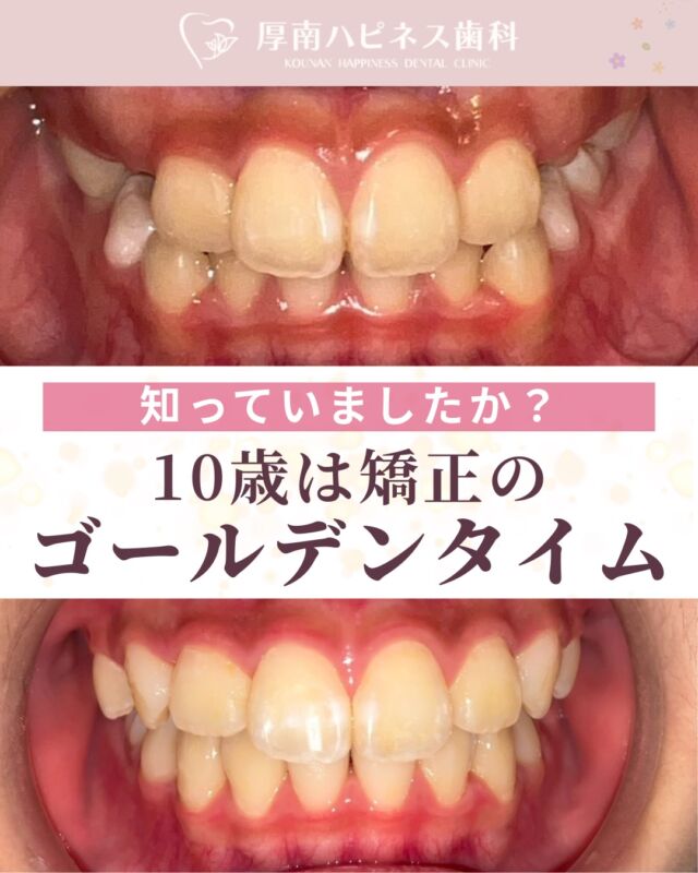 10歳は矯正のゴールデンタイムって知っていますか？🦷✨

「歯並びが気になるけど、まだ様子見でいいかな…」
そう思っているうちに、お口の状態は少しずつ変化していきます。

実は10歳前後は、
あごの成長を利用しながら矯正を始めやすい大切な時期です。

大人になってから矯正を始めると…

✔️ 抜歯が必要になることがある
✔️ 治療期間が長くなる
✔️ あごの成長を活かせない

など、治療の選択肢が限られてしまうこともあります。

もちろん全員が今すぐ矯正を始める必要はありません😊

ただ、

☑️ 前歯がガタガタしている
☑️ 口がぽかんと開いている
☑️ 下あごが出ている・受け口が気になる

このようなサインがあれば、一度相談してみるのがおすすめです。

お子さまの将来の歯並びを考えるなら、
「まだ大丈夫かな？」ではなく
「今の状態を知っておこう」が大切です✨

気になることがあればお気軽にご相談ください😊

宇部市で
安心できる口元美容なら
厚南ハピネス歯科へ。

📌あとで見返したい方は
【保存】がおすすめです。

――――――――――――――――
📍山口県宇部市｜厚南ハピネス歯科
📞0836-43-6800
🪄ご予約・無料相談はプロフィールリンクから
――――――――――――――――

#小児矯正 #歯列矯正 #子どもの歯並び #矯正相談 #受け口