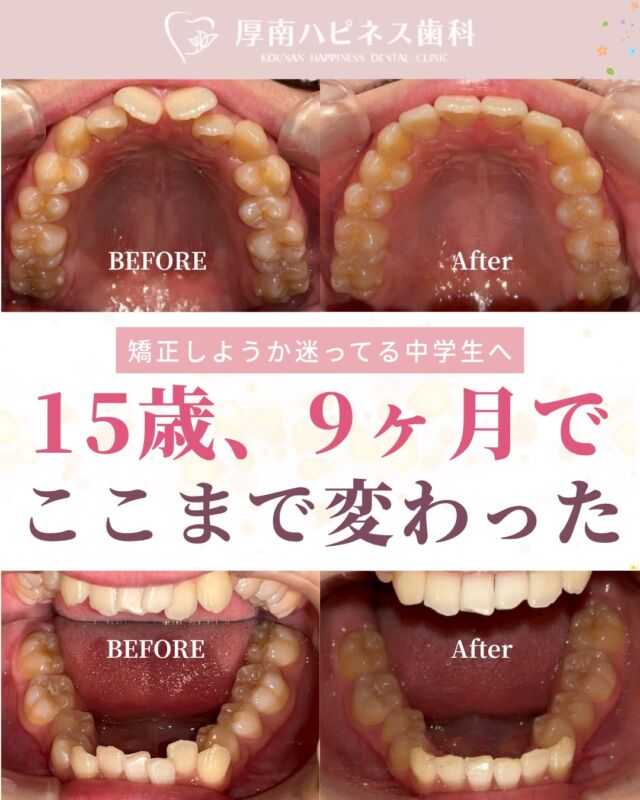 【15歳🌼、9か月でここまで変わりました】

「前歯のガタガタが気になる…」
「笑う時につい口元を隠してしまう…」

そんなお悩みを抱えていた15歳の患者さま😩

矯正には不安もありました💦

☑ 痛そう
☑ 部活に影響しないかな？
☑ 装置が目立つのは嫌だな…
☑ 費用も気になる…

そこで選んだのが、透明で目立ちにくいマウスピース矯正。

最初の1〜2週間は
「うまく外せない」
「しゃべりにくい」
と戸惑うこともありましたが、少しずつ慣れていきました✨

そして9か月後…

気になっていた歯並びが整い、
笑顔にも自信が持てるようになりました😊

歯並びのお悩みは、見た目だけでなく
✔ 歯磨きのしやすさ
✔ むし歯・歯周病予防
✔ 将来のお口の健康

にも関わってきます。

「うちの子にも矯正が必要かな？」
「どんな方法が合っているんだろう？」

そんな疑問があれば、
まずはお気軽にご相談ください🦷

一人ひとりのお口の状態に合わせて
ご提案いたします。

宇部市で
安心できる口元美容なら
厚南ハピネス歯科へ。

📌あとで見返したい方は
【保存】がおすすめです。

―――――――――――――
📍山口県宇部市｜厚南ハピネス歯科
📞0836-43-6800
🪄ご予約・無料相談はプロフィールリンクから
―――――――――――――

#宇部市歯医者
#宇部市歯科
#宇部市美