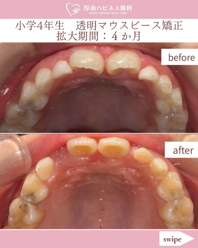 🦷✨ 小学4年生のお子さまの症例です。

お子さまの成長期は、歯や顎の成長を考えながら、永久歯が並ぶスペースを確保していくことがあります。

今回の症例では、

📝 治療期間：約4か月
💰 費用：約48万円前後

透明マウスピース型装置は、装置が目立ちにくいことが特徴のひとつです。

「子どもの歯並びが気になる」
「矯正はいつから始めたらいい？」
「できるだけ目立ちにくい方法で治療したい」

そんなお悩みがありましたら、お気軽にご相談ください☺️

お子さまのお口の状態や成長には個人差があります。
診察・検査を行ったうえで、一人ひとりに適した治療方法をご提案します。

━━━━━━━━━━━━━━

🌸 厚南ハピネス歯科

📞 0836-43-6800
📍 山口県宇部市厚南北1-3-23
　際波グランフォート3号

🚗 駐車場あり

━━━━━━━━━━━━━━

⚠️ 治療についての注意事項

※治療期間・治療結果・費用には個人差があります。
※矯正治療には、歯の移動に伴う痛みや違和感、歯ぐきの炎症、むし歯、歯根の吸収などのリスクがあります。
※治療後に歯が元の位置に戻ろうとすることがあります。
※治療内容や適応については、診察・検査の結果によって異なります。
※症例写真は、患者さまの同意を得て掲載しています。

#厚南ハピネス歯科
#宇部市矯正
#子どもの矯正
#小児矯正
#透明マウスピース型装置