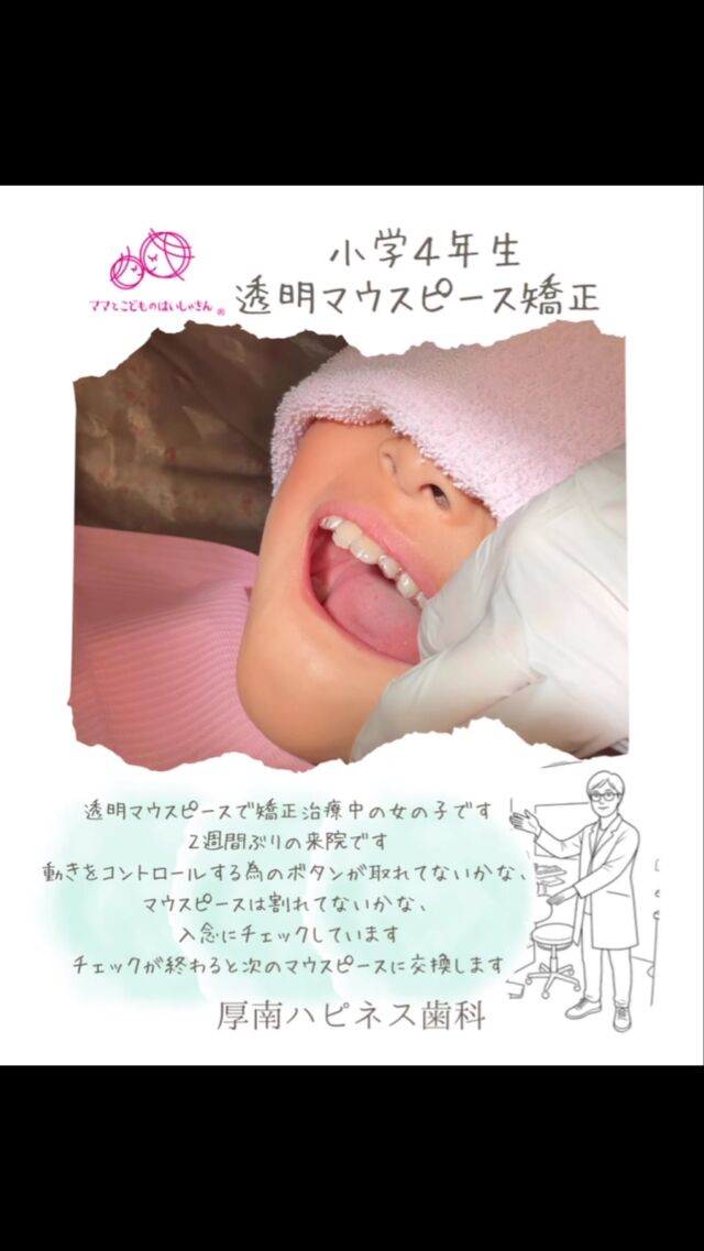 🦷💕 わたし、マウスピース矯正してるよ〜！

マウスピースをつけて、
毎日コツコツがんばってるよ😊✨

2週間に1回、歯医者さんに行って
先生に「どうかな〜？」って
チェックしてもらうの👀🦷

「上手にできてるよ！」って言ってもらえると
うれしい〜！🥰

最初はちょっぴりドキドキしたけど、
今はもうすっかり慣れたよ✌️💕

少しずつ変わっていくのが楽しみ♪

これからもがんばるぞ〜！🌈✨

「わたしもやってみたい！」って思ったら
先生に聞いてみてね🦷💕

━━━━━━━━━━━━━━

🌸 厚南ハピネス歯科

📞 0836-43-6800

📍 山口県宇部市厚南北1-3-23
　際波グランフォート3号

🚗 駐車場あり

━━━━━━━━━━━━━━

#子どもの矯正
#マウスピース矯正
#小児矯正
#宇部市歯医者
#厚南ハピネス歯科