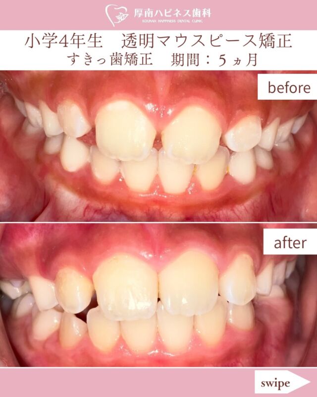 今回は、小学4年生のお子さまの
すきっ歯・歯並びに対して、透明マウスピース型装置を使用した症例をご紹介します。

成長期のお子さまは、これから生えてくる永久歯のことも考えながら、
歯が並ぶためのスペースを整えていくことがあります。

今回の症例では、
歯を並べるためのスペースを確保する拡大治療と、歯並びを整える治療を行いました。

📝 治療期間：約5か月
💰 費用：約48万円前後

透明マウスピース型装置は、
装置が目立ちにくいことが特徴のひとつです。

「子どもの歯並びが気になる」
「すきっ歯が気になる」
「矯正はいつから始めたらいい？」
「できるだけ目立ちにくい方法で治療したい」

そんなお悩みがありましたら、
お気軽にご相談ください☺️

お子さまのお口の状態や成長には個人差があります。
診察・検査を行ったうえで、一人ひとりに合わせた治療方法をご提案します。

━━━━━━━━━━━━━━

🌸 厚南ハピネス歯科

📞 0836-43-6800

📍 山口県宇部市厚南北1-3-23
　際波グランフォート3号

🚗 駐車場あり

━━━━━━━━━━━━━━

⚠️ 治療についての注意事項

※治療期間・治療結果・費用には個人差があります。
※矯正治療には、歯の移動に伴う痛みや違和感、歯ぐきの炎症、むし歯、歯根の吸収などのリスクがあります。
※治療後に歯が元の位置に戻ろうとすることがあります。
※治療内容や適応については、診察・検査の結果によって異なります。
※症例写真は、患者さまの同意を得て掲載しています。

#厚南ハピネス歯科
#宇部市矯正
#子どもの矯正
#小児矯正
#透明マウスピース型装置