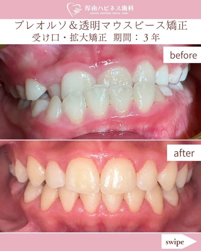 今回は、受け口のお子さまの症例をご紹介します。

① 受け口のご相談
受け口が気になるとのことで矯正治療を決められました。

② プレオルソ＋舌のトレーニング
プレオルソを使用しながら、舌の使い方を身につけるトレーニングにも取り組みました。

その結果、約2週間で受け口の状態に改善がみられました。

③ 透明マウスピース型装置による拡大矯正へ
その後は、クロスバイト（上下の歯が横にずれて噛み合う状態）の改善も目指し、歯が並ぶスペースを確保する拡大治療をスタートしました。

お子さまの矯正治療では、歯並びだけでなく、舌の使い方やお口の機能にも目を向けることが大切です。

成長段階やお口の状態に合わせて、治療を進めていきます☺️

📝 治療内容：プレオルソ・舌のトレーニング・透明マウスピース型装置による拡大矯正
📅 治療期間：約3年
💰 費用：約48万円前後

「子どもの受け口が気になる」
「噛み合わせがずれている気がする」
「成長期のうちに相談したほうがいい？」

そんなお悩みがありましたら、お気軽にご相談ください。

━━━━━━━━━━━━━━

🌸 厚南ハピネス歯科

📞 0836-43-6800

📍 山口県宇部市厚南北1-3-23
　際波グランフォート3号

🚗 駐車場あり

━━━━━━━━━━━━━━

⚠️ 治療についての注意事項

※治療期間・治療結果には個人差があります。
※矯正治療には、装置の使用に伴う痛みや違和感、むし歯・歯ぐきの炎症、歯根の吸収、治療後の後戻りなどのリスクがあります。
※装置の適応や治療経過は、お口の状態や成長によって異なります。
※費用は約48万円前後です。実際の費用や治療内容については、医院へご確認ください。
※掲載写真は患者さまの同意を得て掲載しています。

#厚南ハピネス歯科
#宇部市矯正
#子どもの矯正
#小児矯正
#受け口